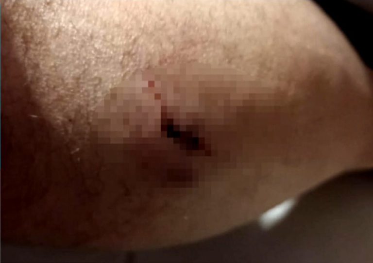 Θεσσαλονίκη: Επίθεση αδέσποτου σκύλου σε κάτοικο του Χορτιάτη